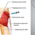 Внутримышечная инъекция в ягодицу: учимся делать самостоятельно