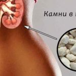 Камни в почках. Лучшие травы для лечения