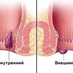 Лечение геморроя дома: быстро, эффективно и дешево