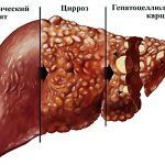 Цирроз печени – лечение народными средствами: 10 проверенных средств