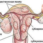 ОТ МИОМЫ И КИСТЫ - НАСТОЙКА ИЗ КЕДРОВЫХ ОРЕШКОВ