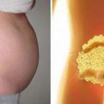 Вот почему у тебя раздутый живот! Как избавиться от вздутия и похудеть за ночь