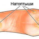 Простые, но эффективные рецепты для устранения натоптышей, трещин, мозолей, сосудистой сетки и варик...