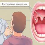 Как избавиться от воспаления миндалин быстро в течение 24 часов