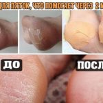Домашнее средство для ваших пяточек! Помогает за минуту!