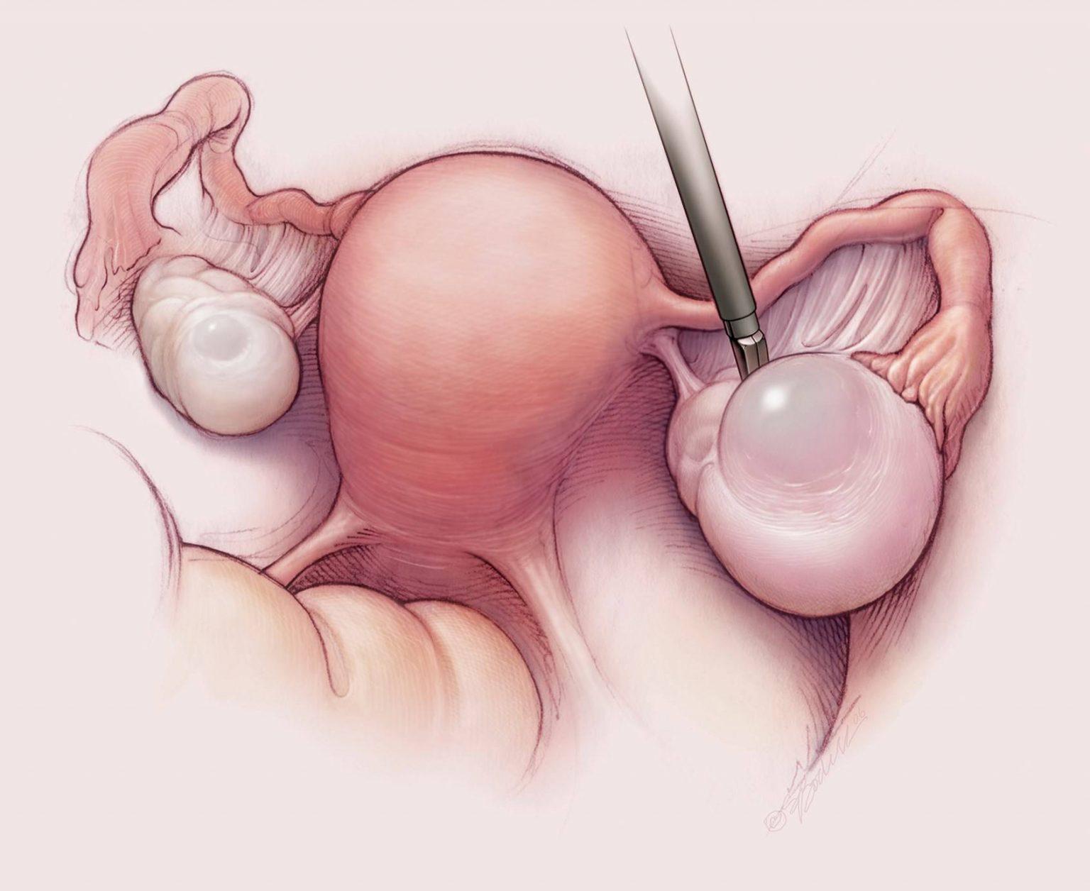 удалены яичники матка испытала оргазм фото 4